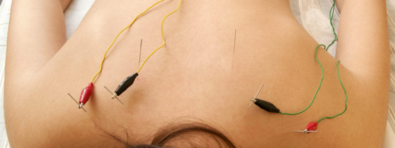 Dry Needle